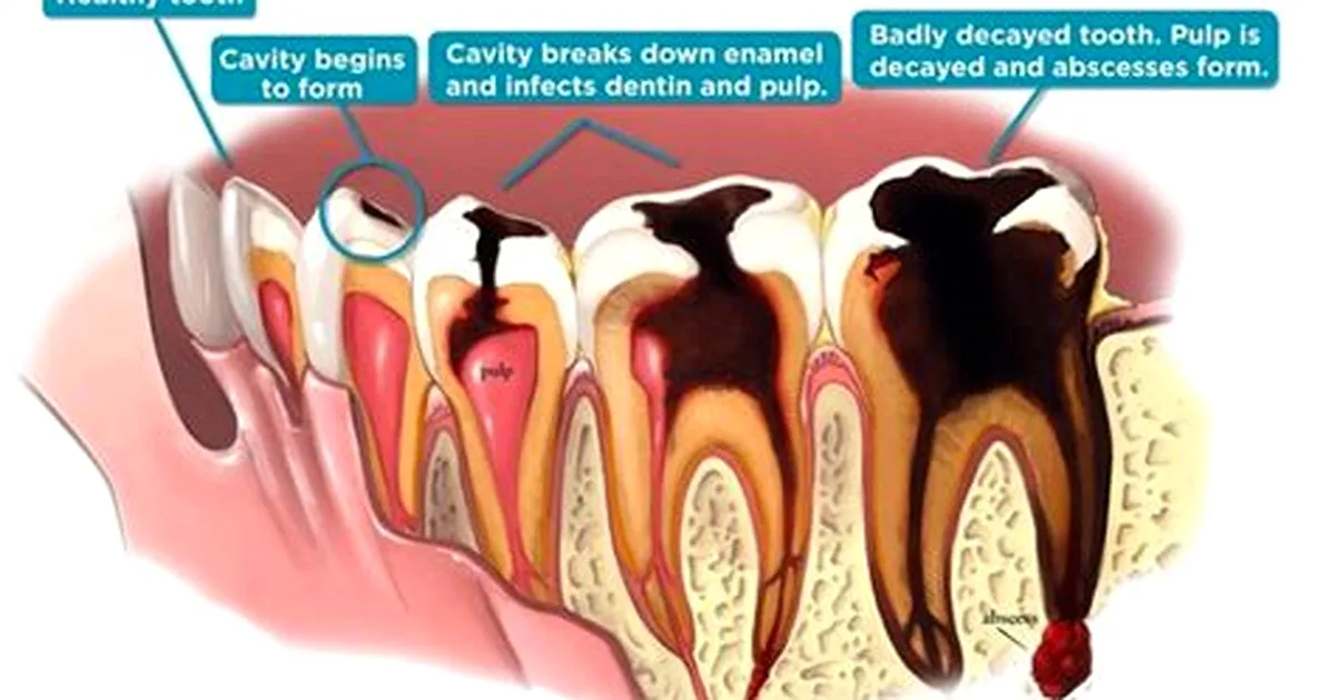 Person holding their cheek in dental pain, wondering if Tylenol helps with tooth pain